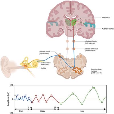 Brainstem evoked auditory potentials in tinnitus: A best-evidence synthesis and meta-analysis